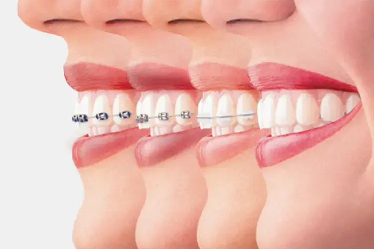 ارتودنسی نامرئی برای اصلاح نامرتبی دندان ها استفاده می شود و حالت نامرئی با کمترین جلب توجه را دارد.
