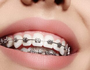 ارتودنسی ثابت برای اصلاح دندان های نامرتب و کج