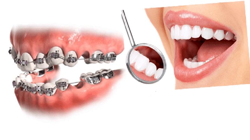 نتایج ارتودنسی دندان
