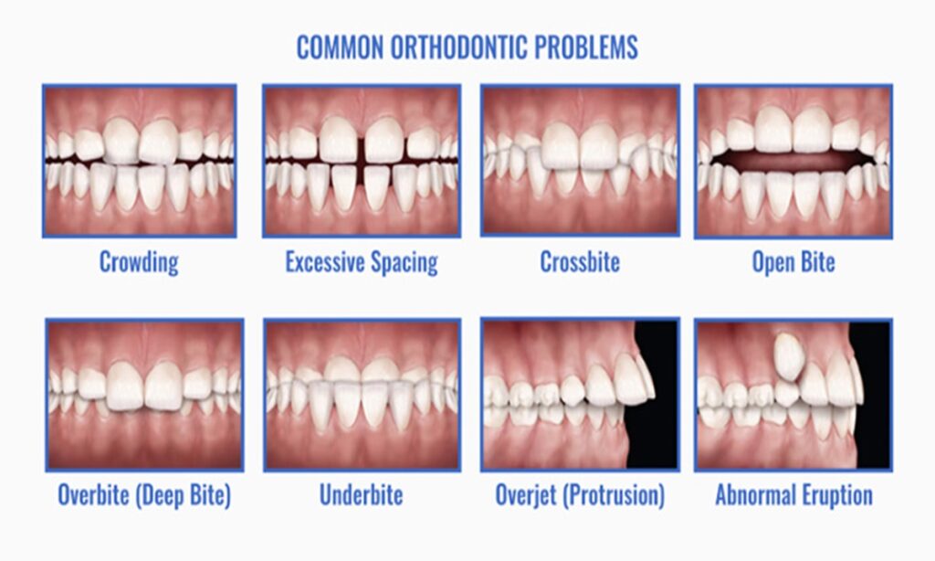 تصویر نشان دهنده  انواع ناهنجاری های دهان و دندان