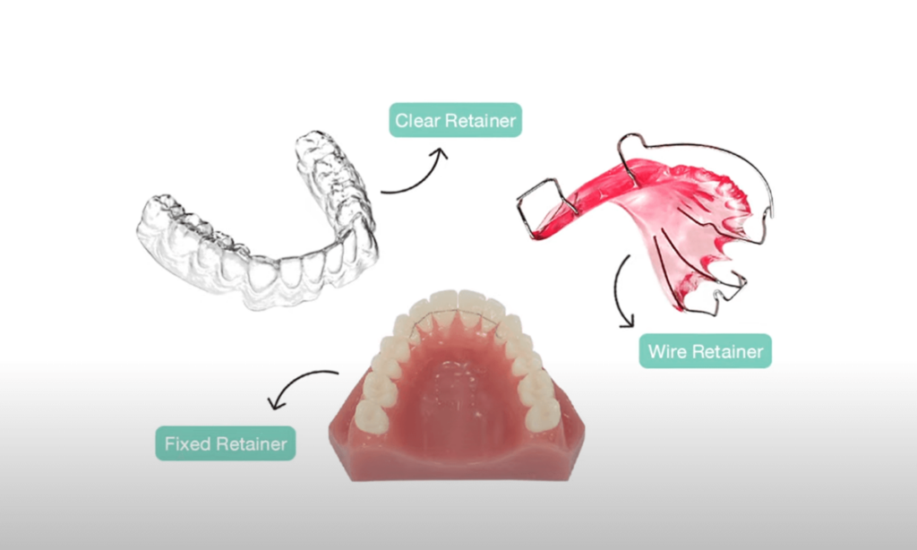 تصویری از انواع مختلف نگهدارنده های ارتودنسی
