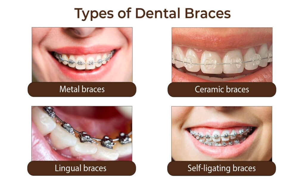  تصویر انواع بریس های ارتودنسی