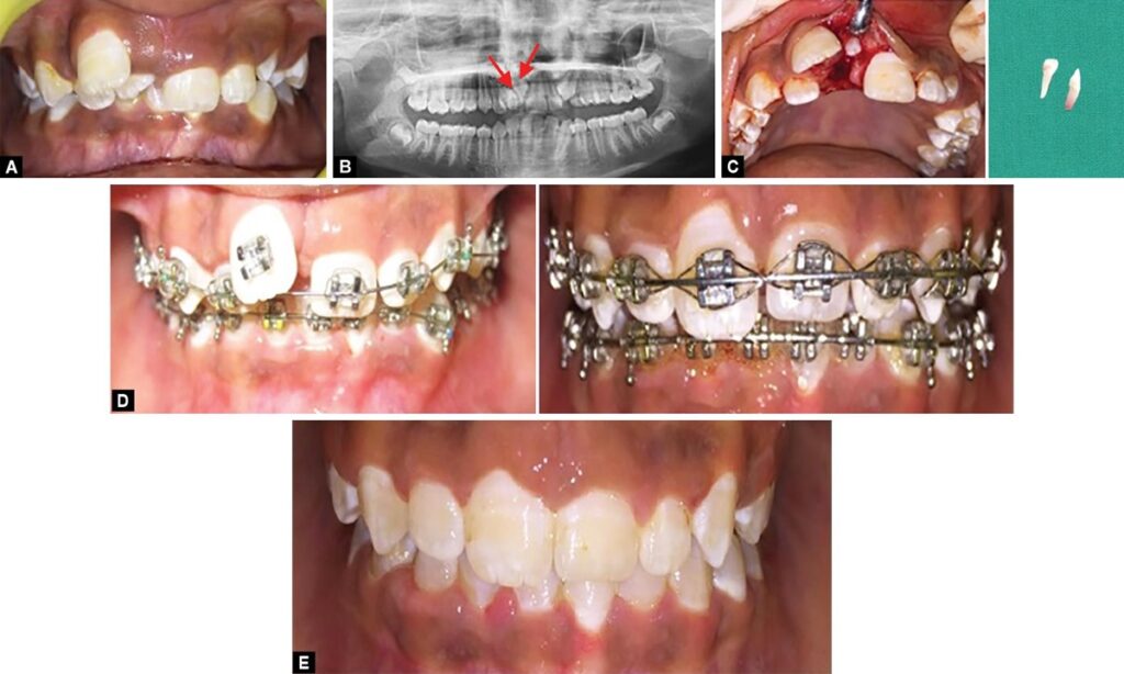 تصاویری از فرآیند درمان دندان اضافه با ارتودنسی