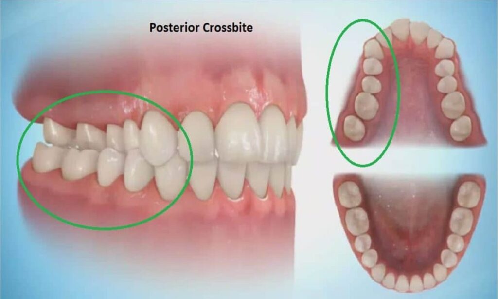 تصویری نشان دهنده کراس بایت خلفی