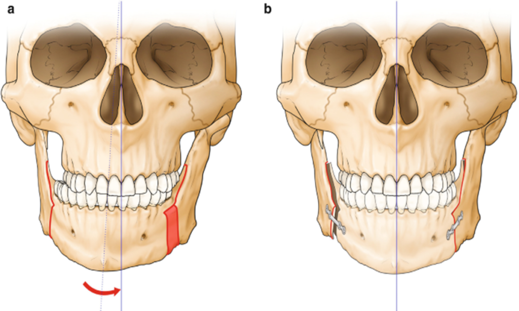 تصویر جراحی فک مندیبل