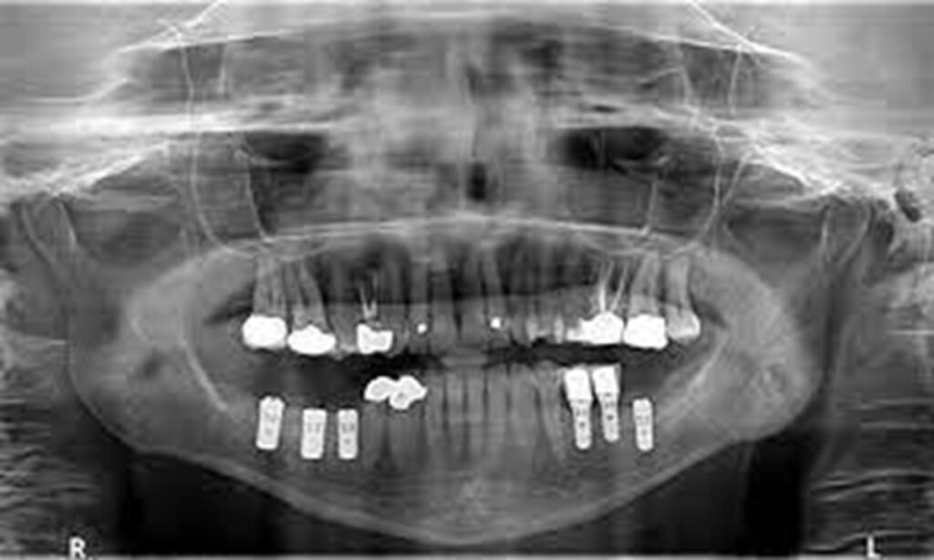 عکس رادیوگرافی از ایمپلنت دندان