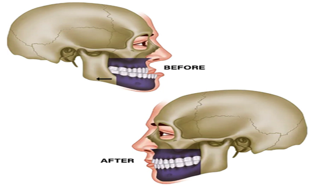 تصویری از قبل و بعد از جراحی فک